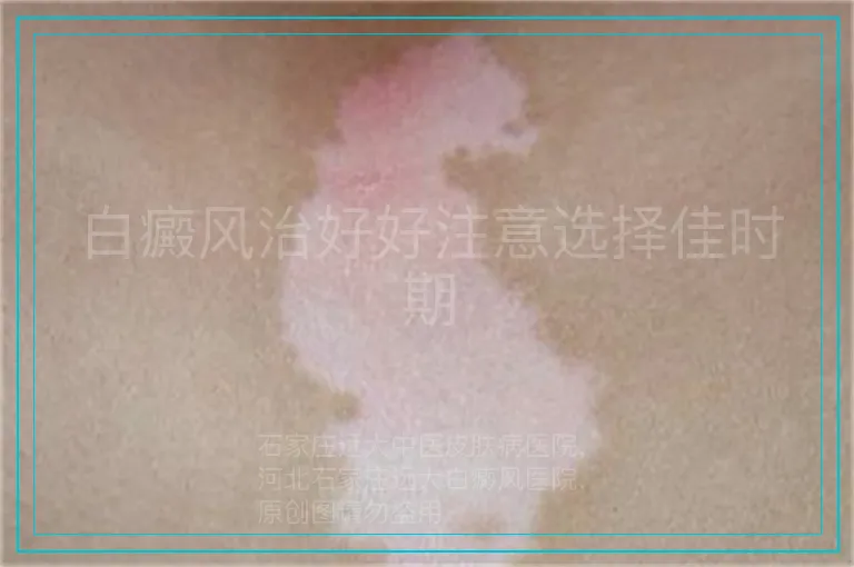白癜风治好好注意选择佳时期