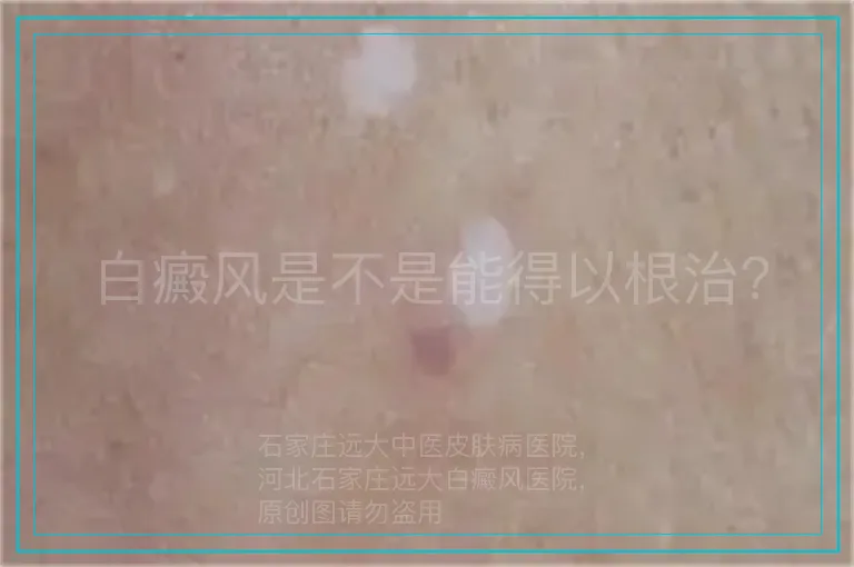 白癜风是不是能得以根治?