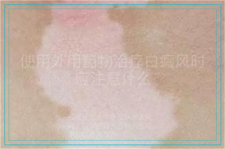 使用外用药物治疗白癜风时应注意什么