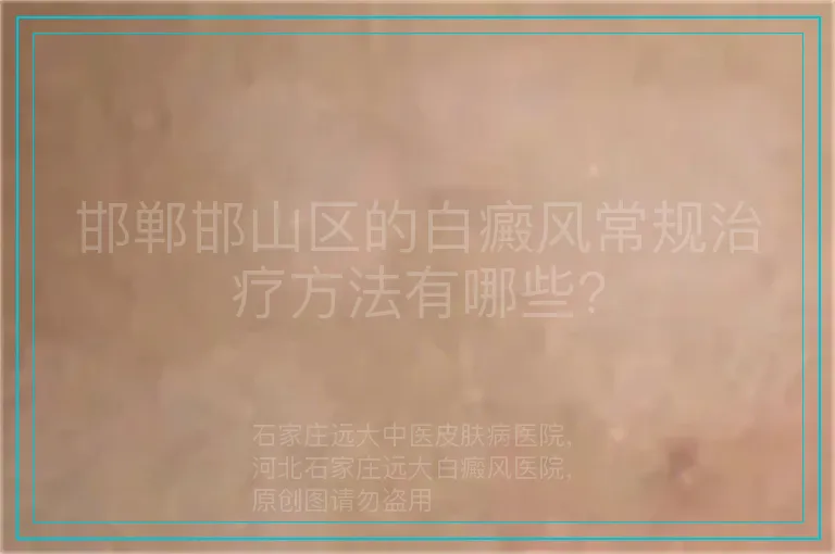 邯郸邯山区的白癜风常规治疗方法有哪些?
