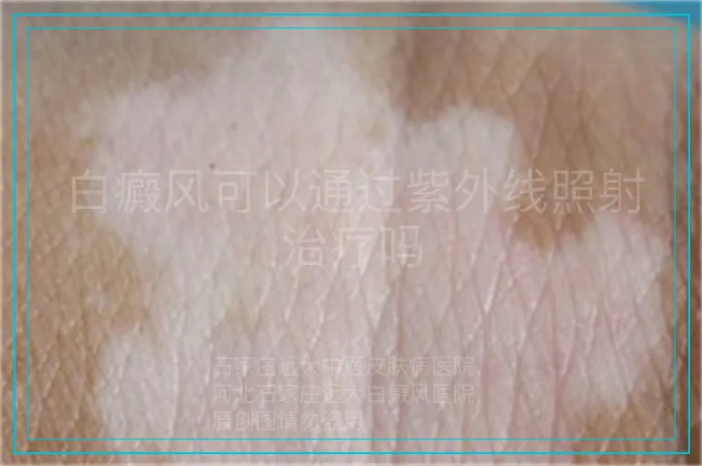 白癜风可以通过紫外线照射治疗吗