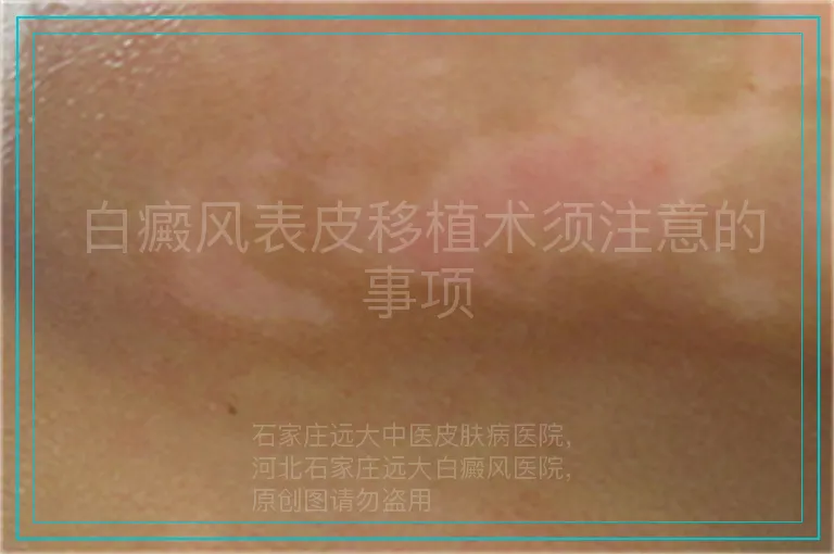 白癜风表皮移植术须注意的事项