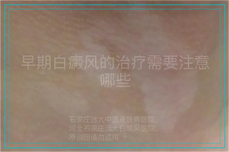 早期白癜风的治疗需要注意哪些
