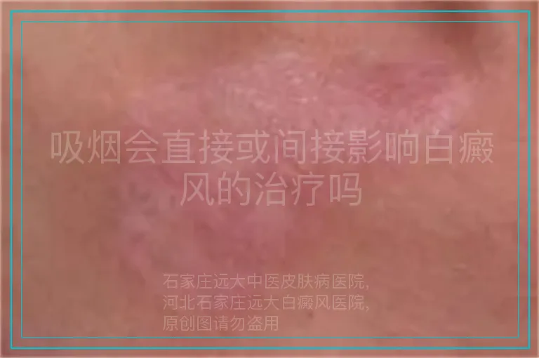 吸烟会直接或间接影响白癜风的治疗吗