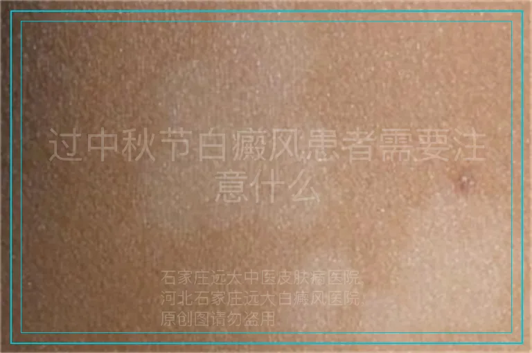 过中秋节白癜风患者需要注意什么