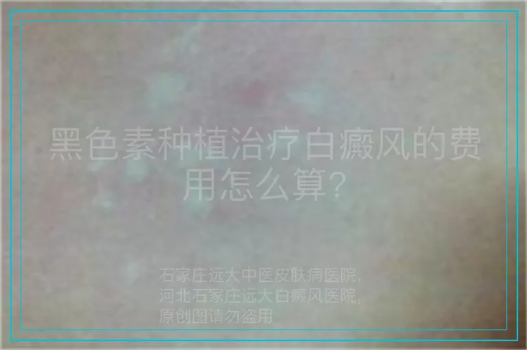 黑色素种植治疗白癜风的费用怎么算?