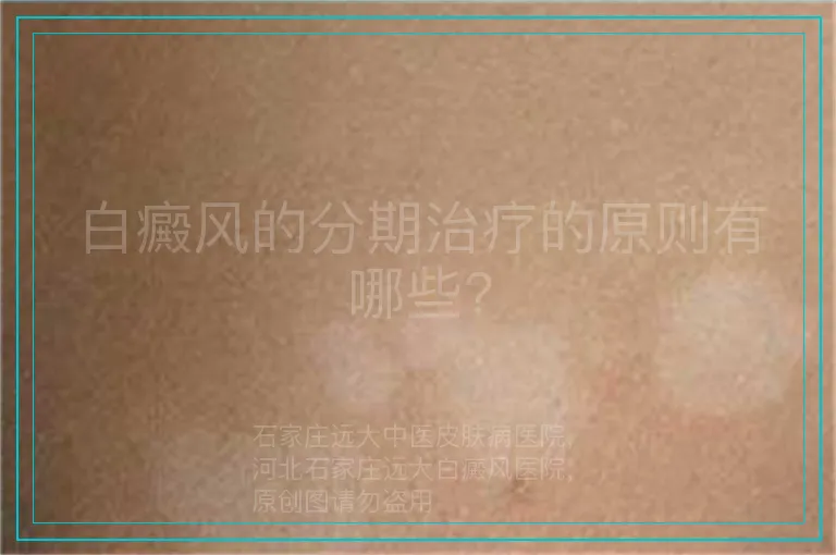 白癜风的分期治疗的原则有哪些?