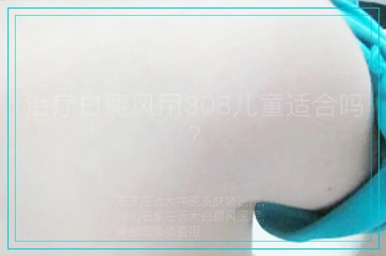 治疗白癜风用308儿童适合吗?
