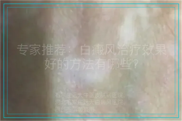 专家推荐：白癜风治疗效果好的方法有哪些?