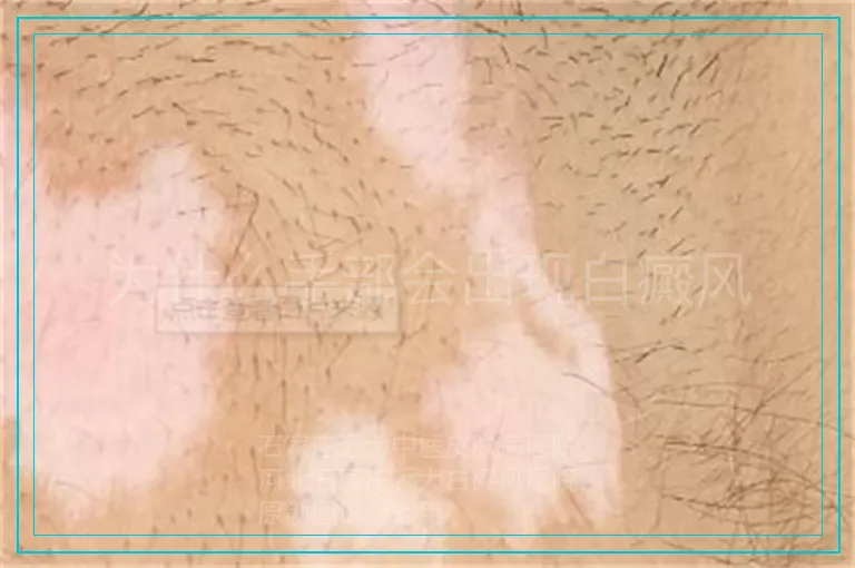 为什么手部会出现白癜风