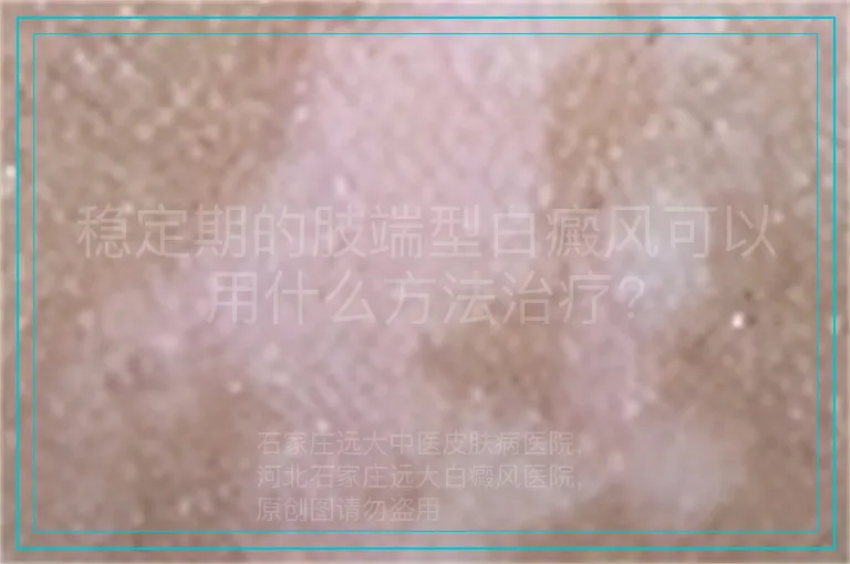 稳定期的肢端型白癜风可以用什么方法治疗?