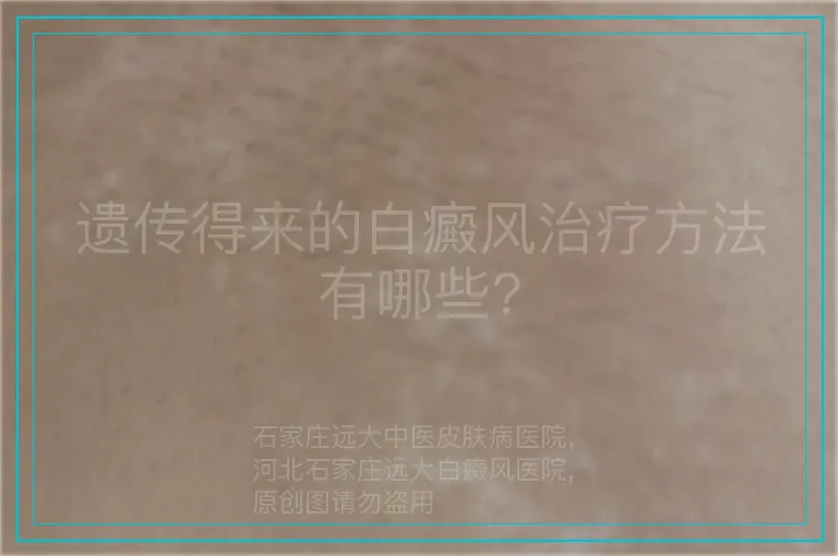 遗传得来的白癜风治疗方法有哪些?