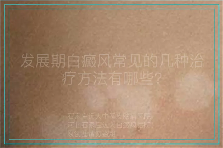发展期白癜风常见的几种治疗方法有哪些?