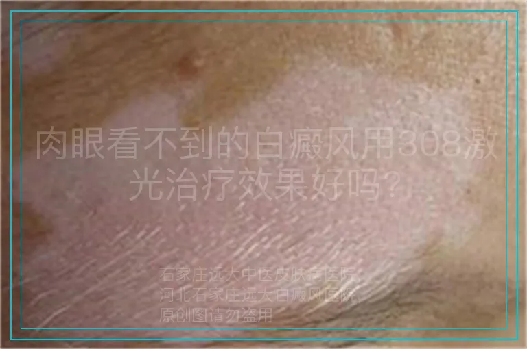 肉眼看不到的白癜风用308激光治疗效果好吗?