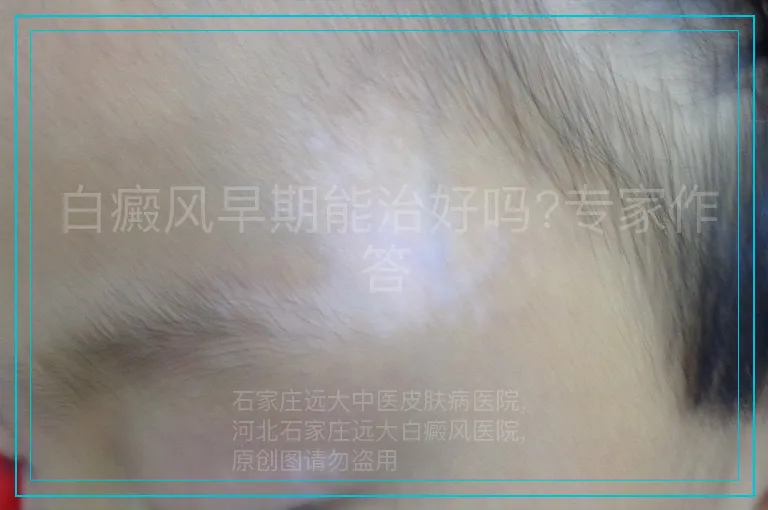 白癜风早期能治好吗?专家作答