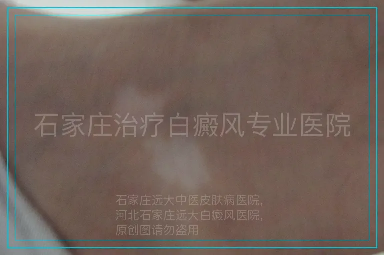 石家庄治疗白癜风专业医院