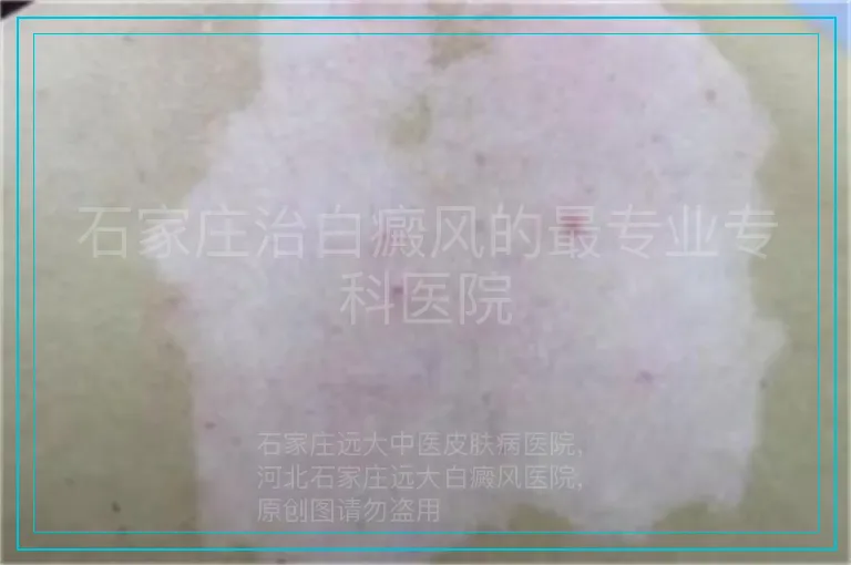 石家庄治白癜风的最专业专科医院
