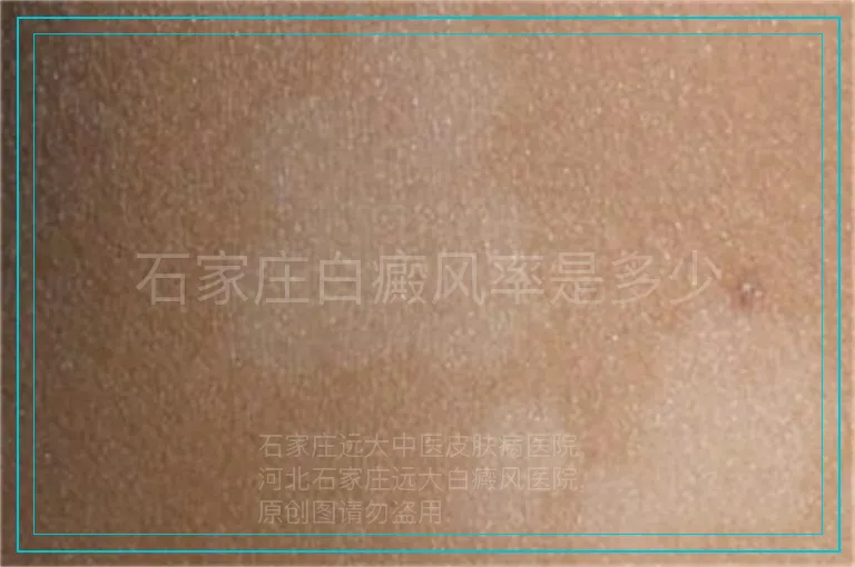 石家庄白癜风率是多少