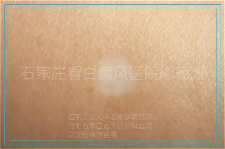 石家庄看白癜风医院哪家好