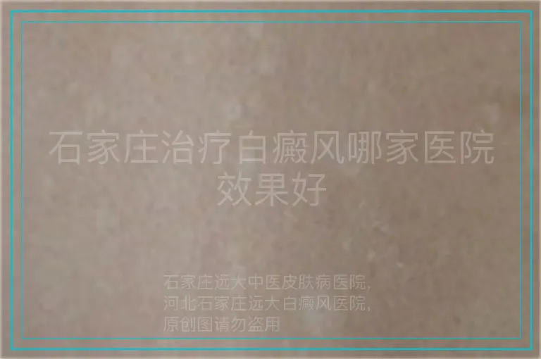 石家庄治疗白癜风哪家医院效果好