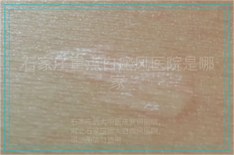 石家庄重点白癜风医院是哪家