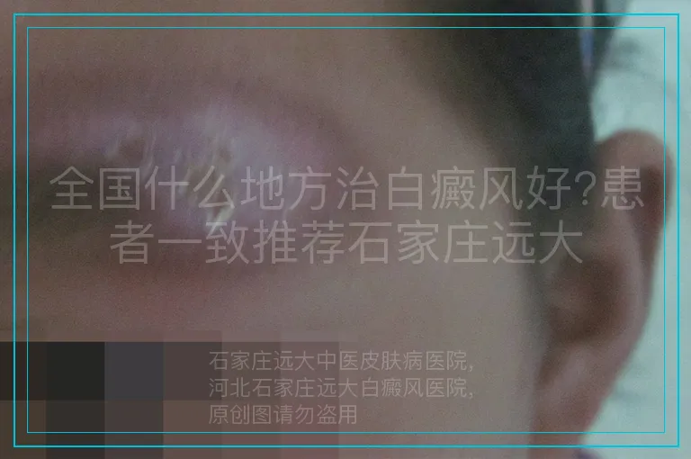 全国什么地方治白癜风好?患者一致推荐石家庄远大