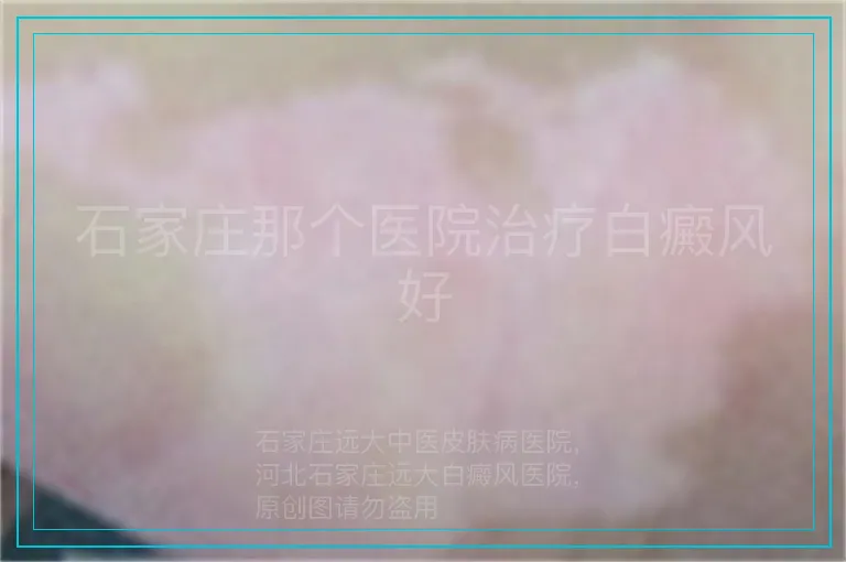 石家庄那个医院治疗白癜风好