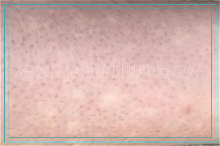 石家庄治白癜风哪个医院好