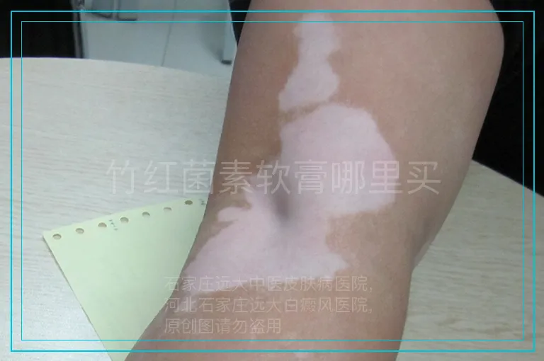 竹红菌素软膏哪里买
