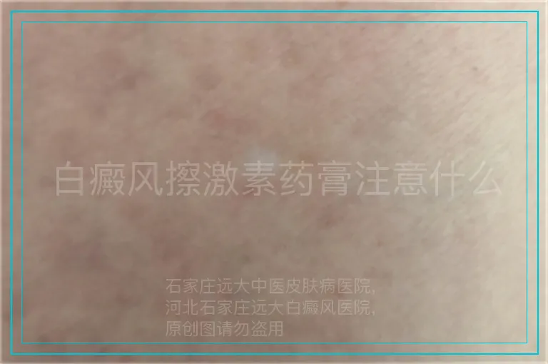 白癜风擦激素药膏注意什么