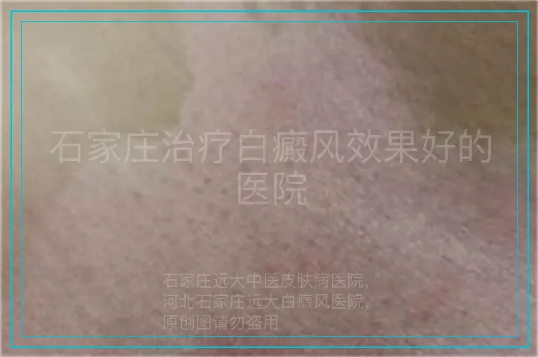 石家庄治疗白癜风效果好的医院