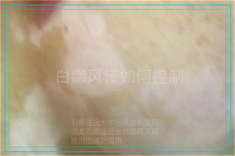 白癜风该如何控制