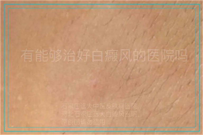 有能够治好白癜风的医院吗