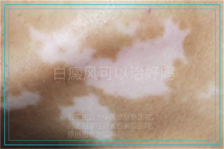 白癜风可以治好吗