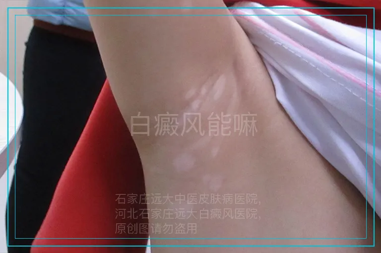 白癜风能嘛