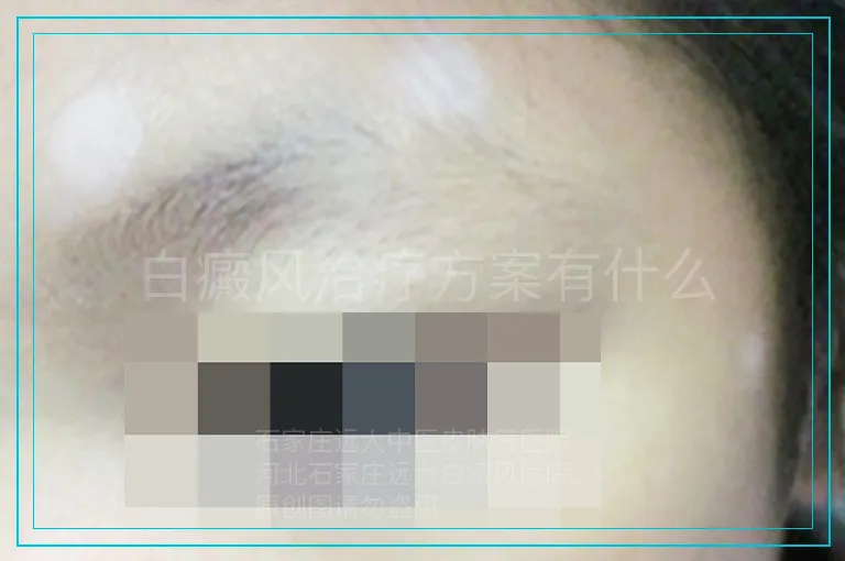 白癜风治疗方案有什么