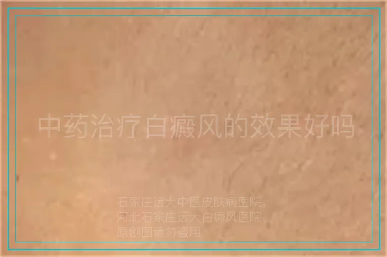 中药治疗白癜风的效果好吗