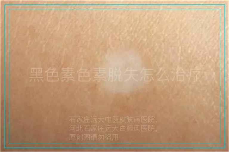 黑色素色素脱失怎么治疗
