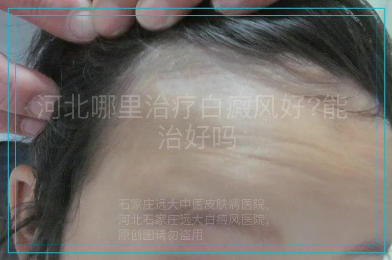 河北哪里治疗白癜风好?能 治好吗
