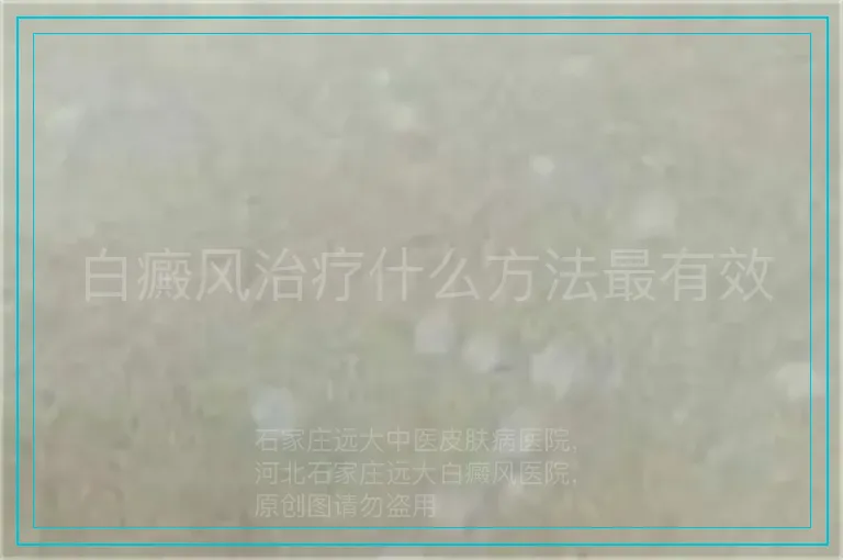 白癜风治疗什么方法最有效
