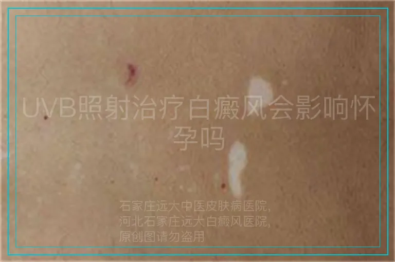 UVB照射治疗白癜风会影响怀孕吗