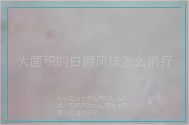 大面积的白癜风该怎么治疗