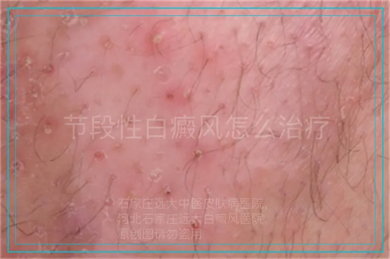节段性白癜风怎么治疗