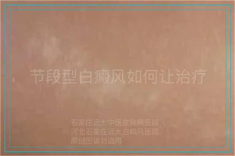 节段型白癜风如何让治疗