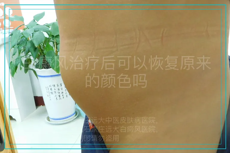 白癜风治疗后可以恢复原来的颜色吗