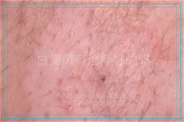 白癜风有治疗好的吗