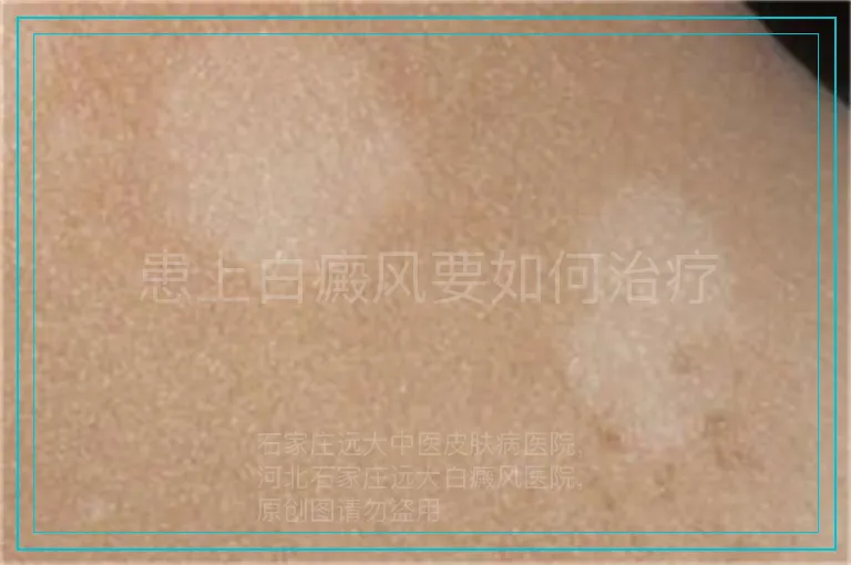 患上白癜风要如何治疗