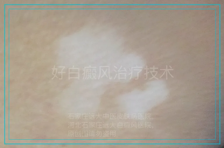 好白癜风治疗技术