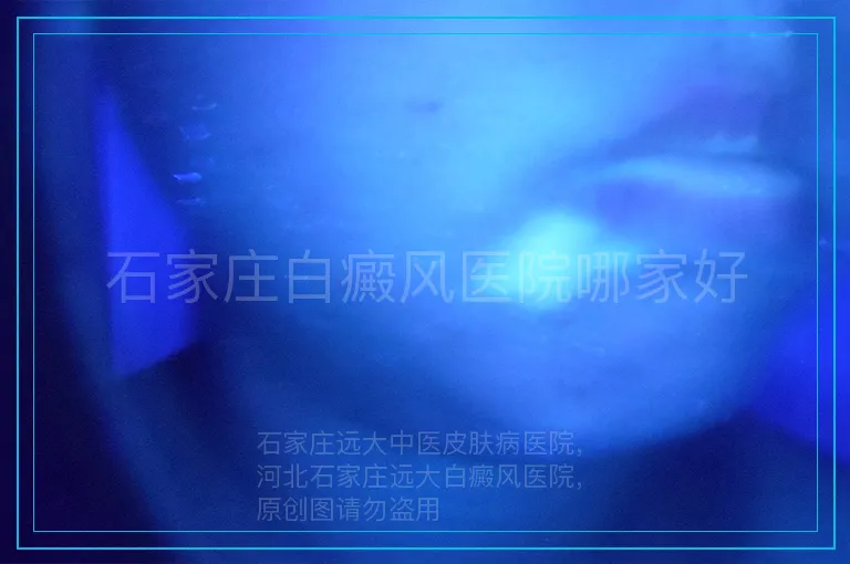 石家庄白癜风医院哪家好