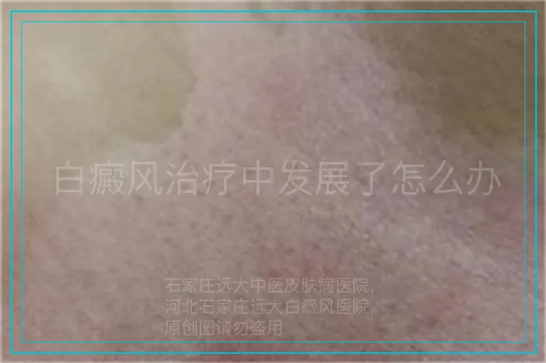 白癜风治疗中发展了怎么办